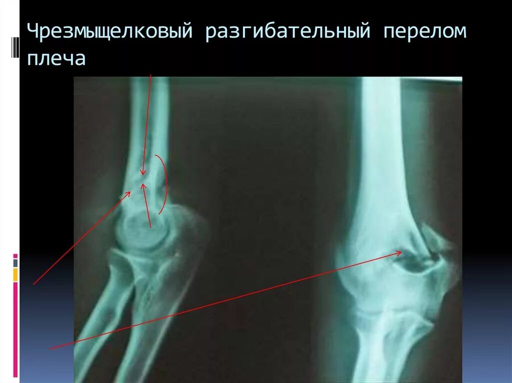 Оскольчатый чрезмыщелковый перелом плечевой кости. Через мыщелковый перелом плеча. Чрезмыщелковый перелом плеча рентген. Чрезмыщелковый перелом плечевой кости у детей. Чрезмыщелковый перелом плечевой.