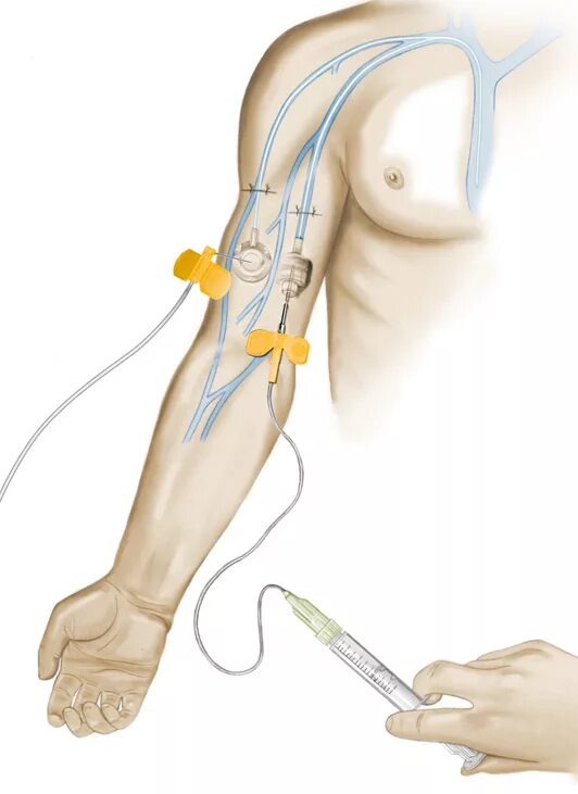Почему после катетера. Подключичный венозный катетер. Периферический имплантируемый Центральный венозный катетер. Бровиак катетер для парентерального питания.