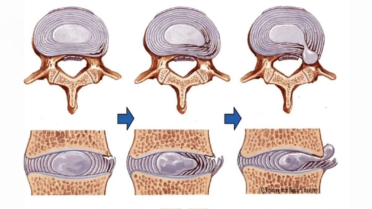 Межпозвонковая протрузия. Протрузия дисков позвоночника что это такое. Грыжа межпозвоночного диска. Протрузия грыжа межпозвонковых дисков. Консервативное лечение грыжи