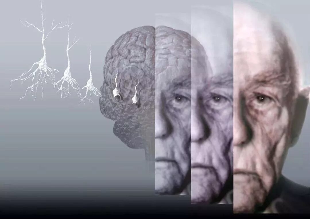 Старческая деменция, болезнь Альцгеймера. Деменция и Альцгеймер. Лакунарная деменция.