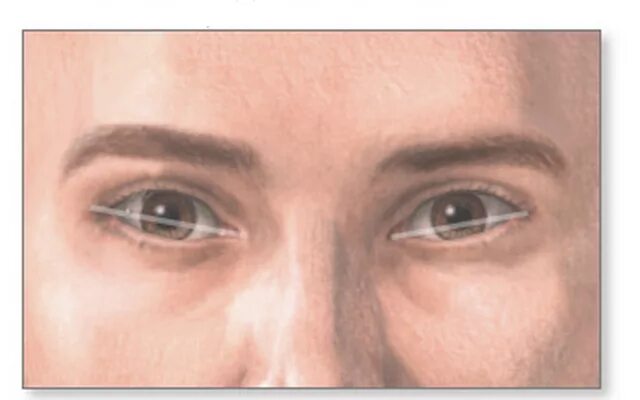 Узкие глаза признак. Эпикантус рудимент. Монголоидный разрез глазных щелей эпикантус. Монголоидный разрез глаз синдром Дауна. Эпикант, монголоидный разрез глаз.