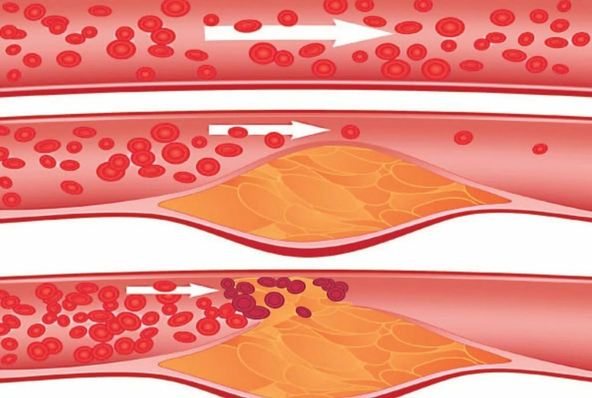 Разрыв кровеносного сосуда. Как очистить сосуды от холестериновых тромбов