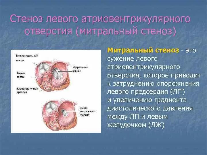 Относительный митральный стеноз. Митральный порог сердца. Экг женщины 51 года с митральным стенозом. Стеноз предсердно желудочкового отверстия. Относительный митральный стеноз.
