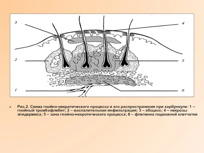 Фурункул карбункул абсцесс флегмона. Локализация основных гнойных процессов в коже и подкожной клетчатки. Карбункул стадия инфильтрации. Карбункул гнойничковые заболевания кожи. Гнойно воспалительный процесс это