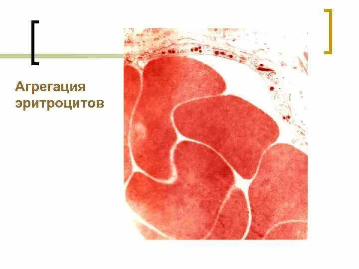 Агрегация эритроцитов это