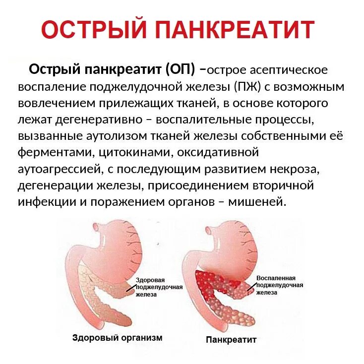 Панкреатит симптомы заболевания. Болезнь поджелудочной железы панкреатит. Симптомы проявления острого панкреатита. Острый панкреатит основные синдромы. Панкреатин поджелудочная железа.