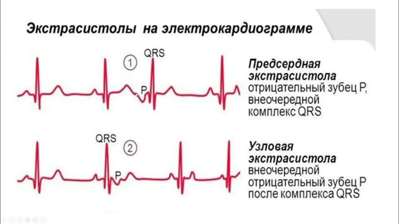 Наджелудочковая экстрасистола на ЭКГ. Экстрасистола желудочков на ЭКГ. Наджелудочковая экстрасистолия на ЭКГ. Одиночная наджелудочковая экстрасистолия на ЭКГ. 10 экстрасистола