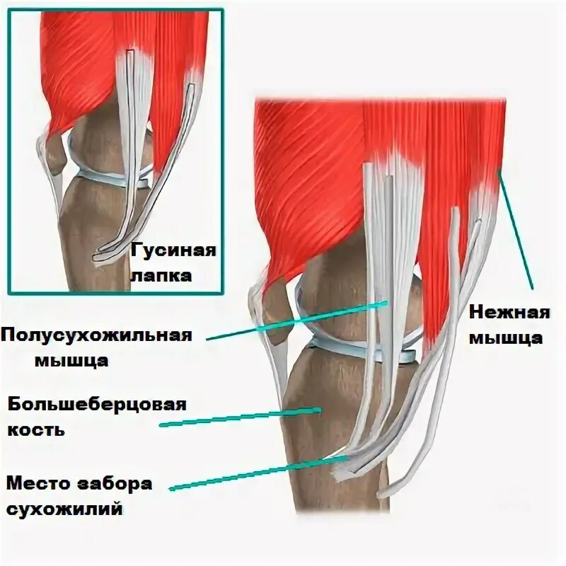 Сухожилия гусиной лапки коленного сустава анатомия. Область гусиной лапки коленного сустава. Сумка гусиной лапки коленного сустава анатомия. Гусиная лапка коленного сустава анатомия.
