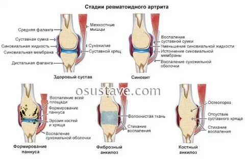 Ревматоидный артрит начальная стадия
