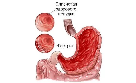 Может ли гастродуоденит. Острый и хронический гастрит.