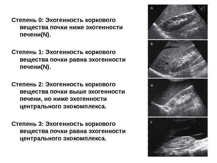 Диффузное уплотнение ЧЛС почек УЗИ. Эхогенность коркового слоя почки в норме. Уплотнение паренхимы почки УЗИ. Эхоструктура неоднородная УЗИ почек. Кальцинат в печени на узи