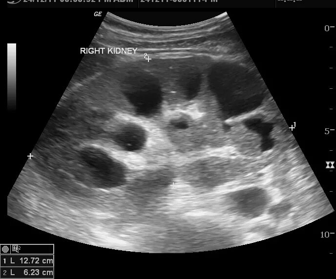 Узи почек диагнозы. Гломерулонефрит на УЗИ почек. УЗИ картина хронического гломерулонефрита. Острый гломерулонефрит УЗИ почек. УЗИ почек гломерулонефрит картина.