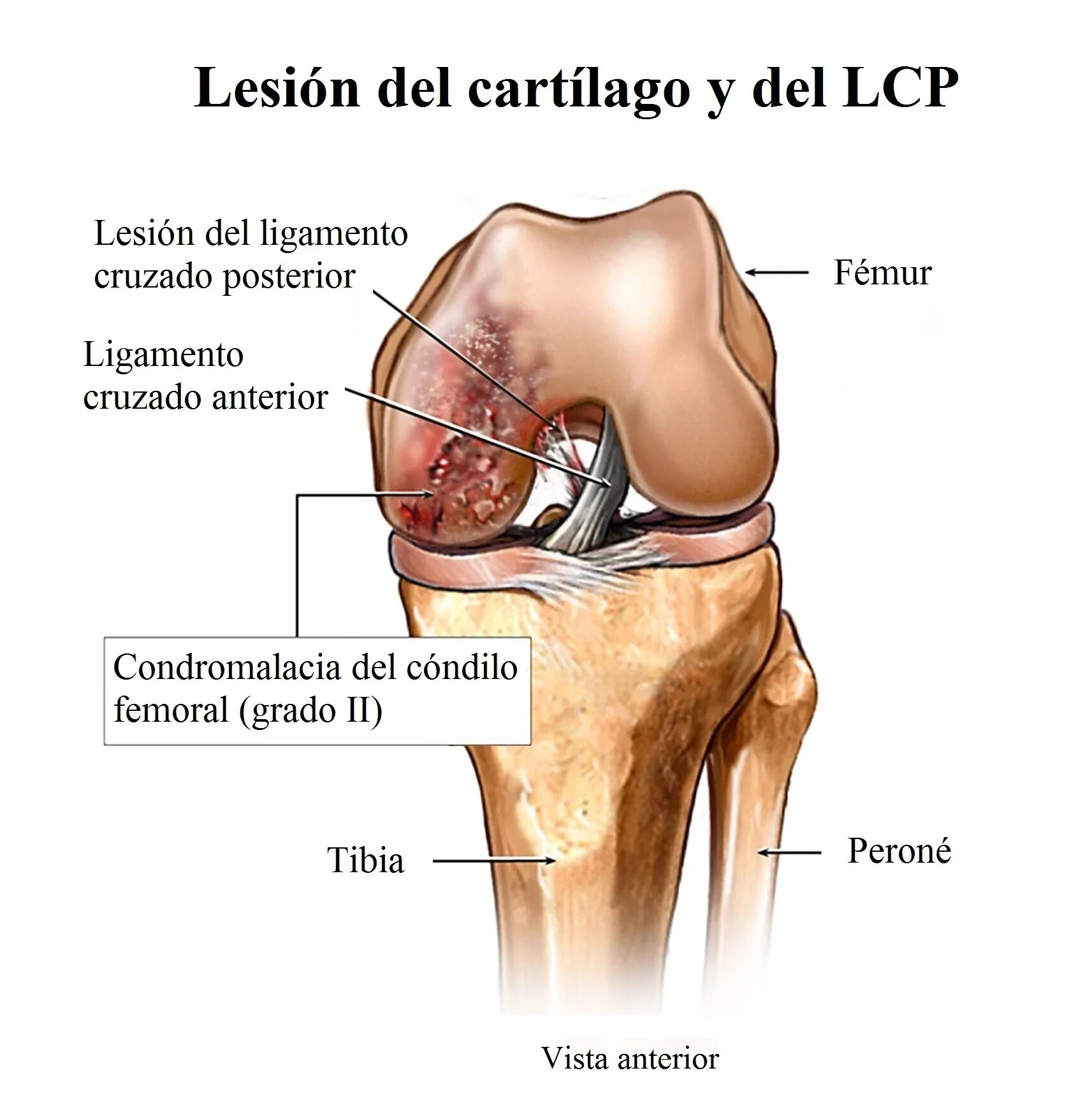 Хондромаляция 2-3 степени коленного сустава. Хондромаляция 3 степени. Хондромаляция надколенника хондромаляция надколенника. Хондромаляция 2 степени коленного сустава. Хондромаляция 3 степени.