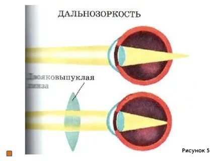 Дальнозоркость биология 8 класс