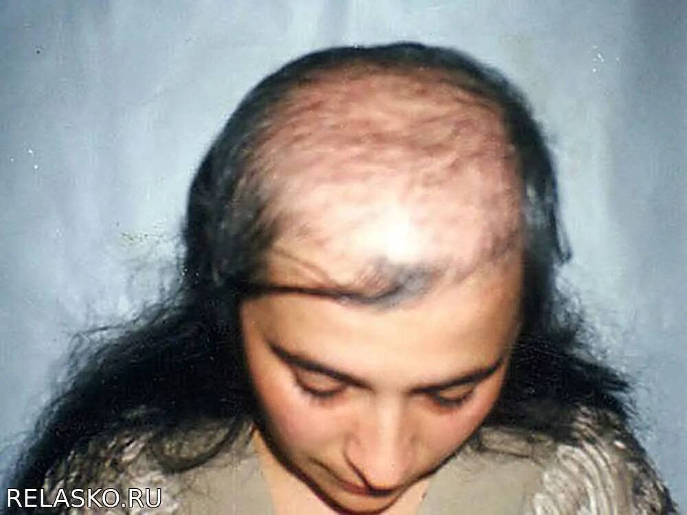 Асбестовидный себорейный дерматит. Проблемные волосы. Экозависимая алопеция. Выпадение волос у женщин. Андрогенетическая алопеция.