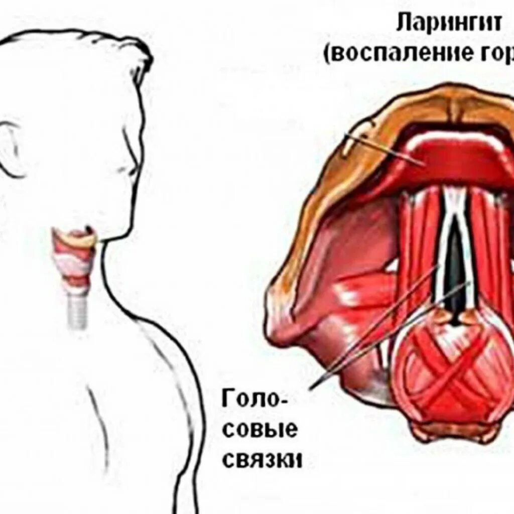 Ларингит как снять отек. Ларингит как снять отек