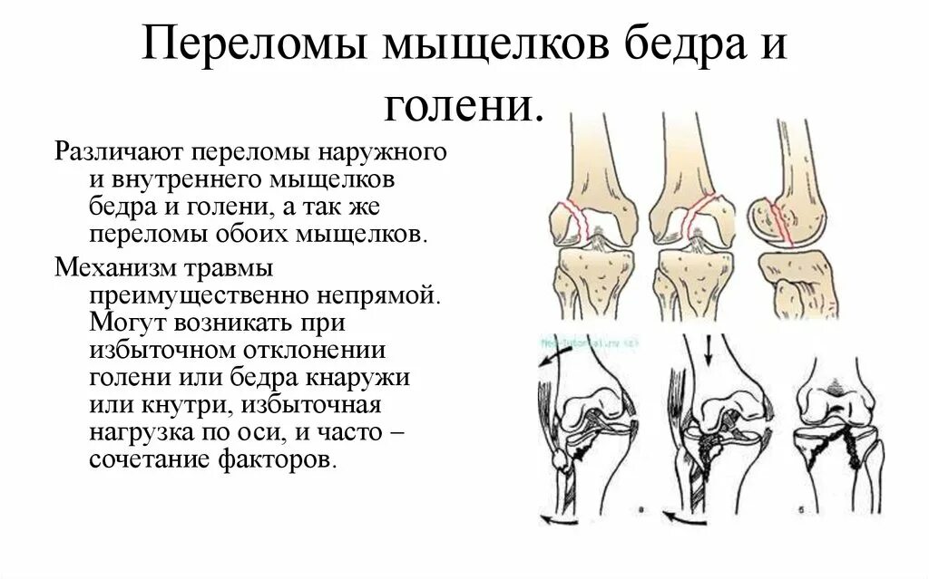 Мыщелок бедренной