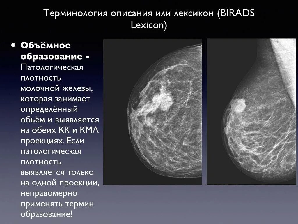 Маммография старый. Очаговое образование молочной железы фиброаденома. Фиброзно-жировая инволюция молочных желез что это такое. Объемное образование в молочной железе. Неоплазия молочной железы.