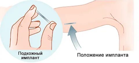 Подкожное противозачаточное