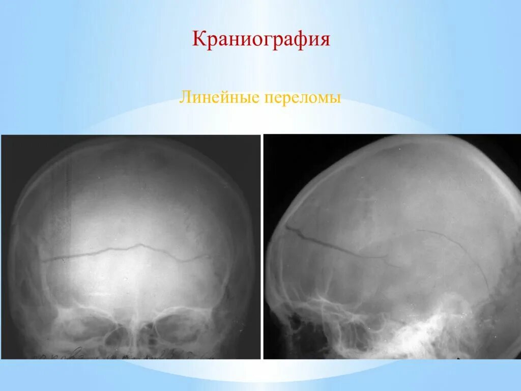 Зчмт сотрясение. Линейный перелом теменной кости. Краниография линейный перелом.