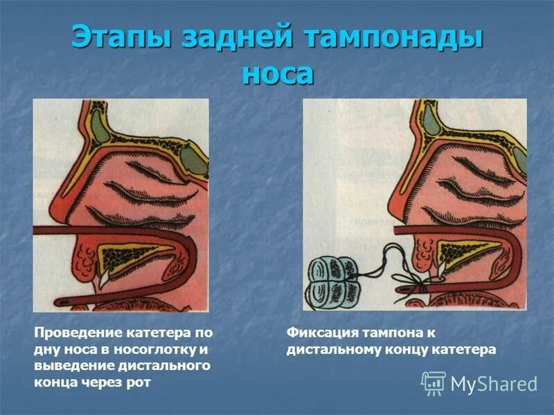 Передняя тампонада при носовом кровотечении. Задняя тампонада при носовом кровотечении алгоритм. Задняя тампонада носа оснащение. Задняя тампонада полости носа. Задняя тампонада носоглотки.