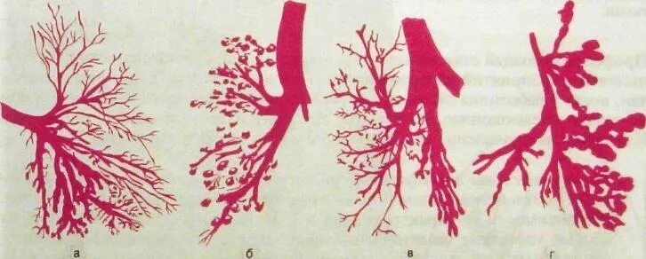Как лечить бронхоэктазы. Бронхография бронхоэктазы. веретенообразные бронхоэктазы. бронхоэктазы гистология. цилиндрические бронхоэктазы.