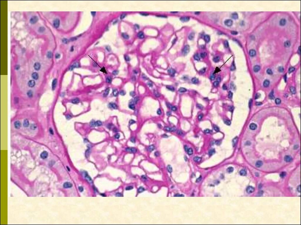Липоидный гломерулонефрит. Гломерулонефрит с полулуниями. Почка микропрепарат гистология. Гистология почечный клубочек норма.