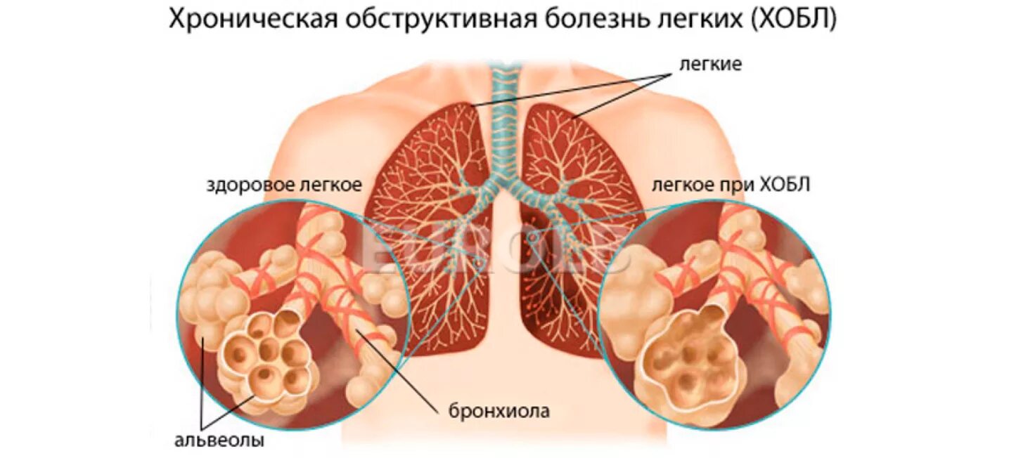 Бронхит латынь. Хроническая обструктивная эмфизема легких. ХОБЛ хронический бронхит эмфизема. Обструктивная болезнь легких — ХОБЛ. Болезнь лёгких эмфизема.