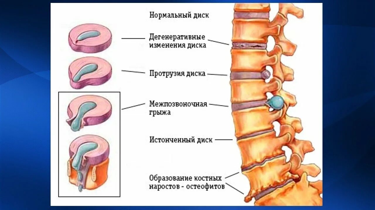 Диффузно дегенеративные. Протрузия позвоночника l2-l3. Дегенеративно-дистрофические изменения l2 l3. Патогенез дегенеративно-дистрофических заболеваний позвоночника. Деформирующий спондилез th9-th10.