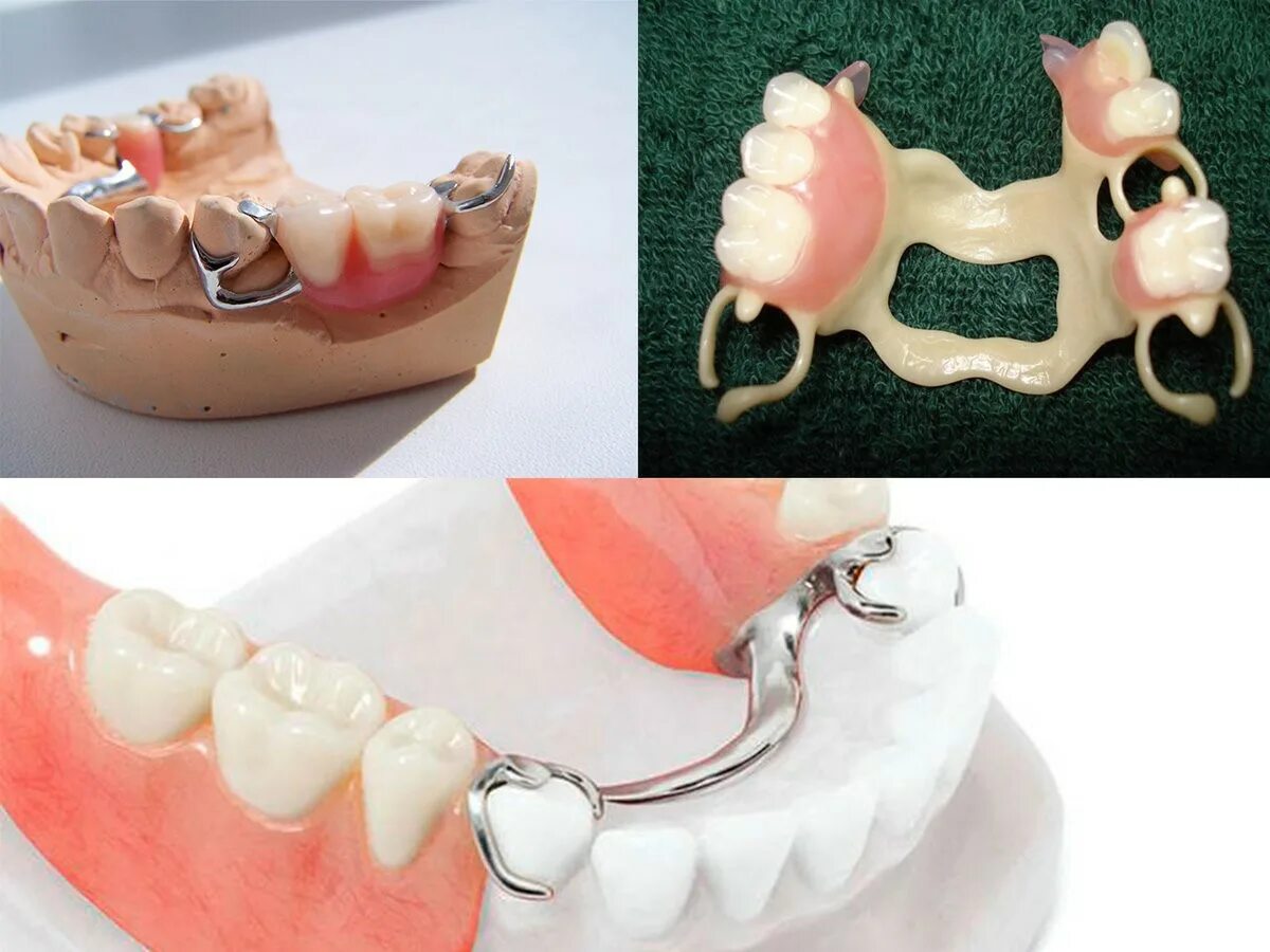 красноярское протезирование. металлокерамические мостовидные протезы. моделировка базиса зубного протеза. мостовидный протез зуб и имплантат. красноярское протезирование.
