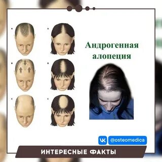 Алопеция что это такое простыми словами
