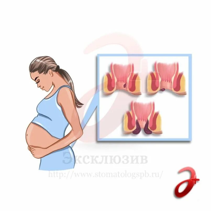 Геморрой при беременности в 3 триместре наружный. Гемморойпри беременности. Геморрой у беременных женщин.