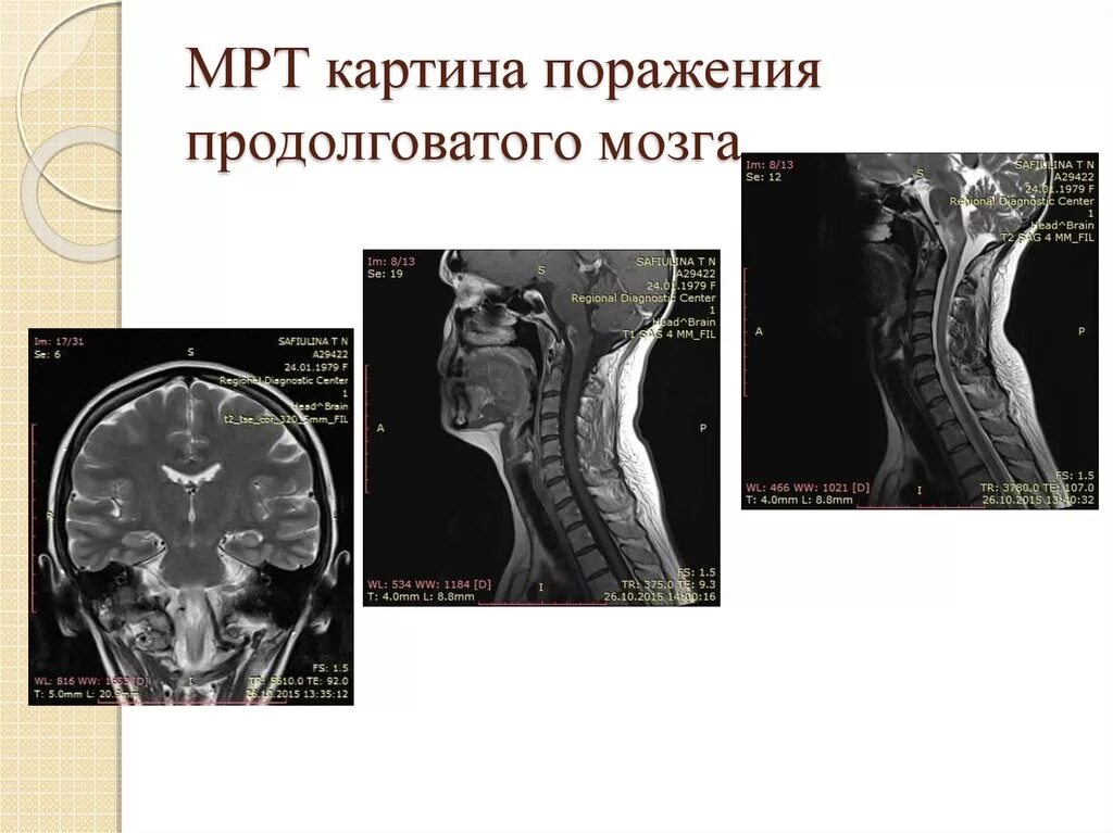 Поражение ствола головного. Мрт ствола мозга норма. Повреждение продолговатого мозга. Анатомия ствола мозга мрт.