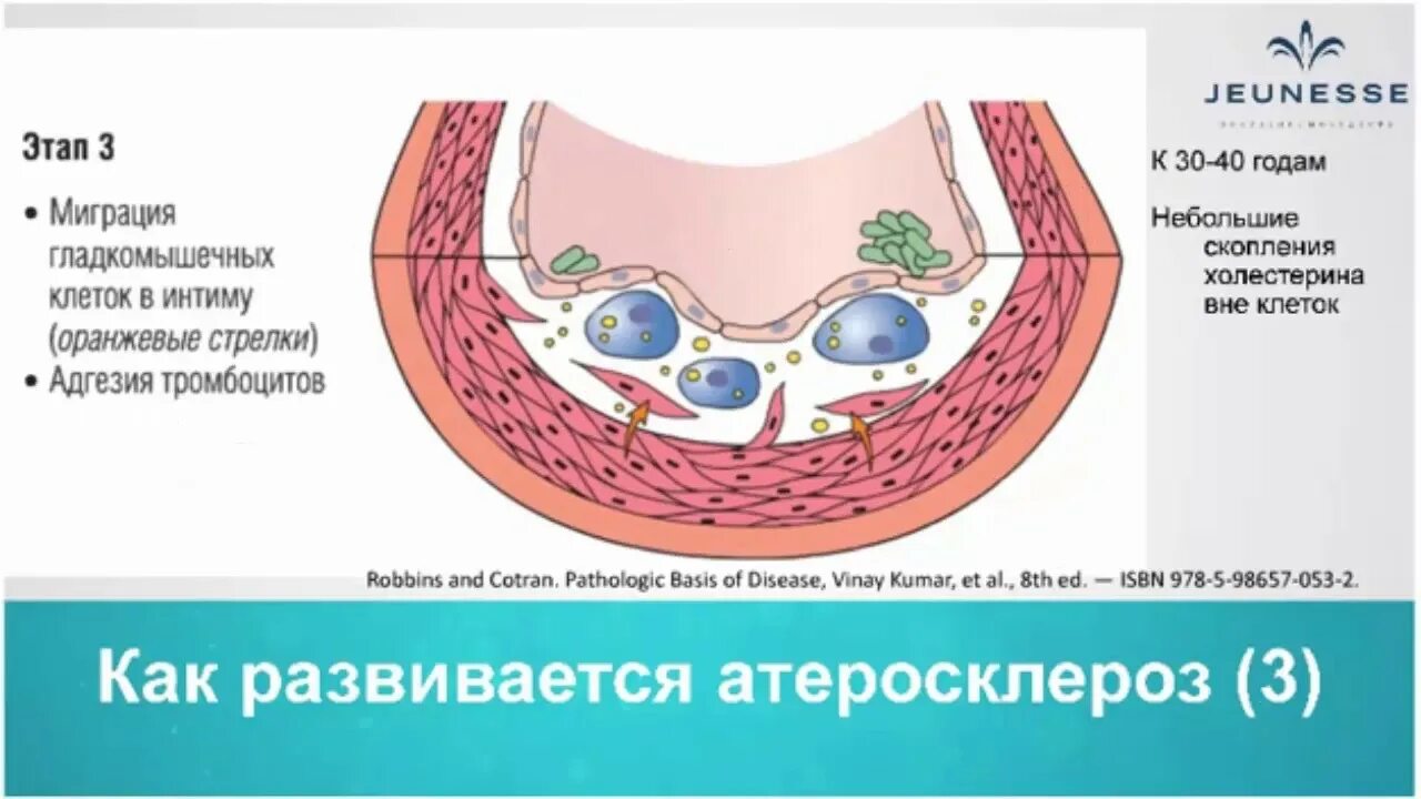 Как избавиться от атеросклероза. Как избавиться от атеросклероза