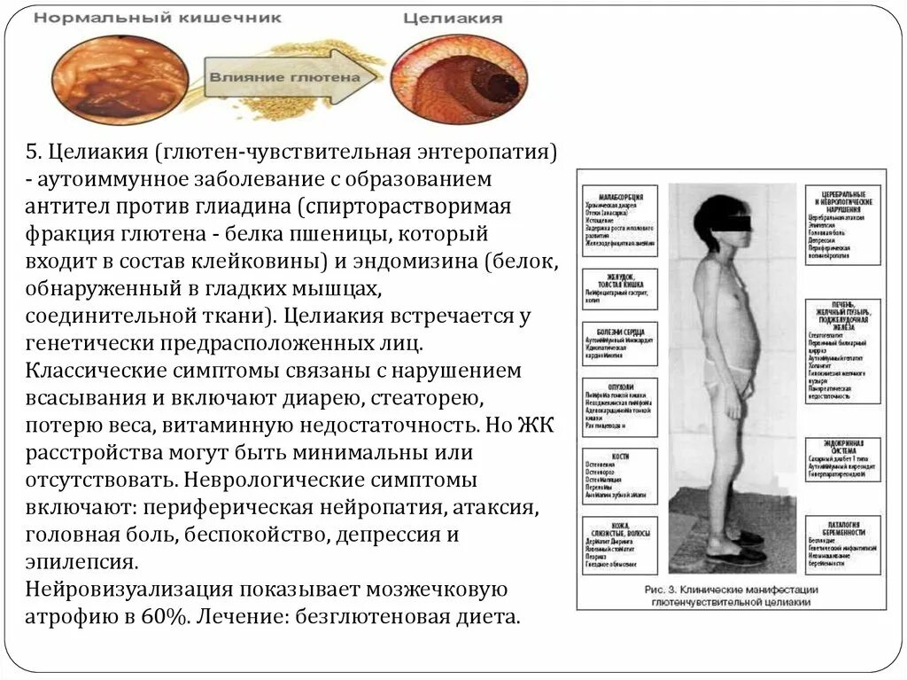 Целиакия или глютеновая болезнь (болезнь ги-Гертера-Гейбнера). Целиакия что это за заболевание у взрослых