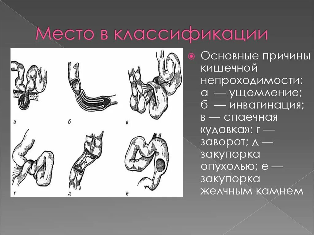 Неопухолевая кишечная непроходимость. Инвагинация петель кишечника. врожденная кишечная непроходимость классификация. острая кишечная непроходимость хирургия. кишечная непроходимость факультетская хирургия.