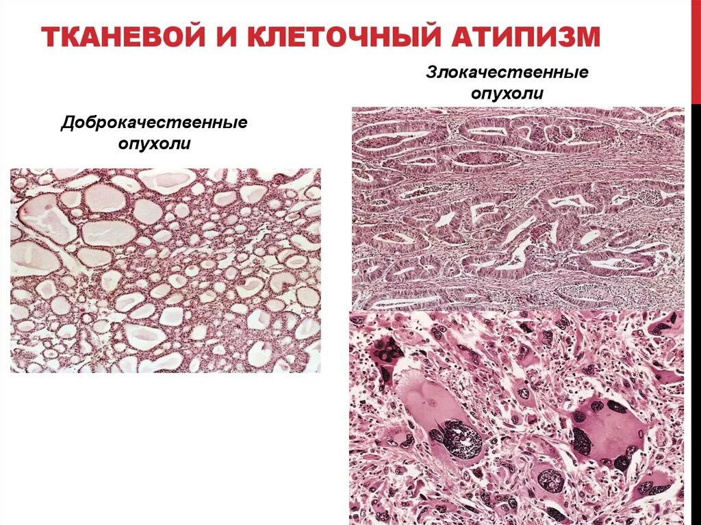 Клетка доброкачественной опухоли. Тканевой атипизм доброкачественных опухолей. Опухолевые клетки патанатомия. Тканевой и клеточный атипизм опухолей. Тканевый атипизм патанатомия.