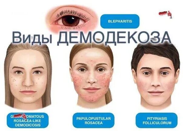 Демодекоз у человека как выглядит Демодекоз у человека как выглядит