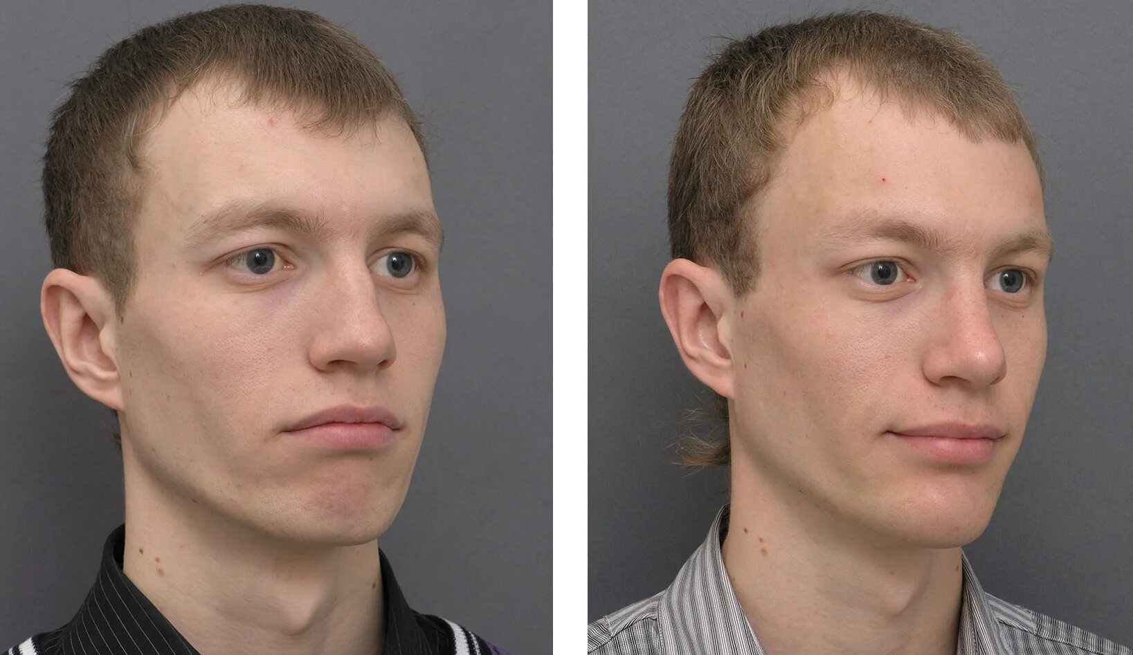 Септопластика искривление носовой перегородки. Гениопластика пластика подбородка. Ринопластика. Операция по феминизации голоса. Ринопластика.