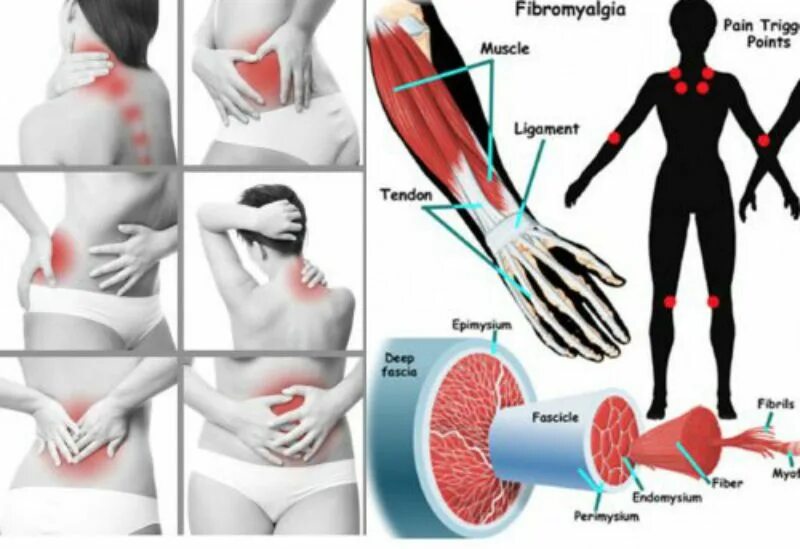 -Фибромиалгия (боль в мышцах). Фибро алгия. Симптомы фибромиалгии. Заболевание мышц Фибромиалгия. Фибромиалгия симптомы причины и лечение
