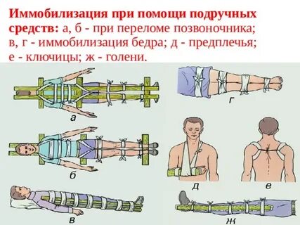 Первая помощь при переломе подручными средствами