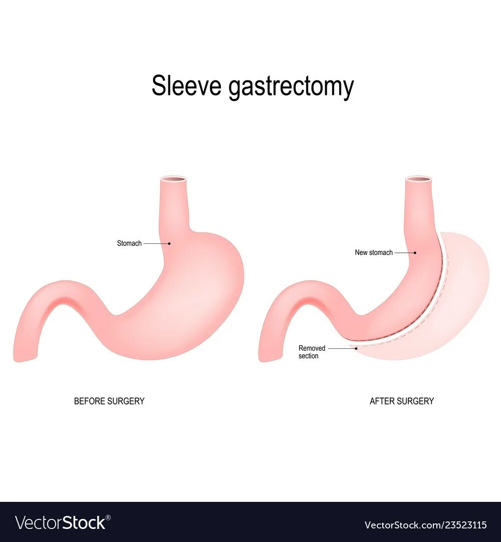 Slive гастрэктэктомия. Как уменьшить желудок без операции