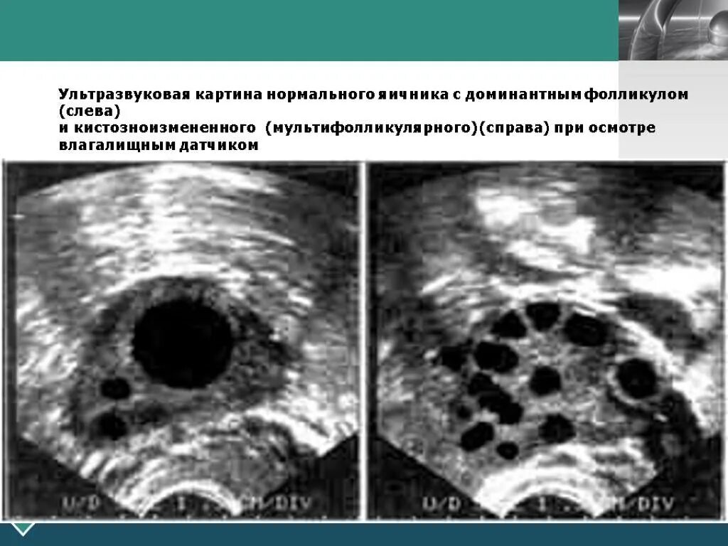 Овуляция видел. Доминантный фолликул на УЗИ. Поликистоз яичников на УЗИ. Как выглядит овуляция на УЗИ.