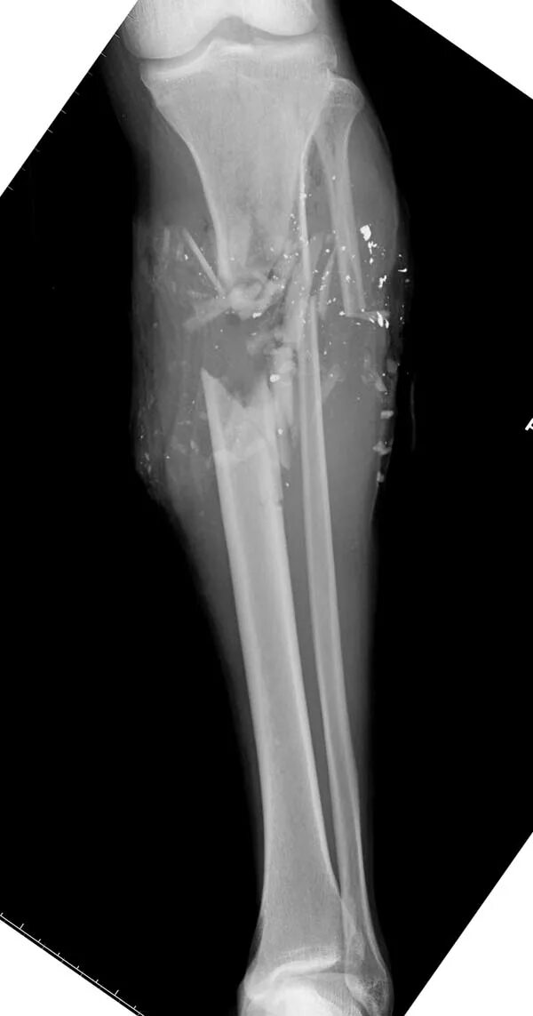 6 недель перелом. Огнестрельный перелом большеберцовой кости. Рентген ноги берцовой кости. Перелом кости голени рентген. Открытый перелом большеберцовой кости.