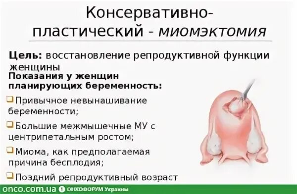 Множественные миома лечение