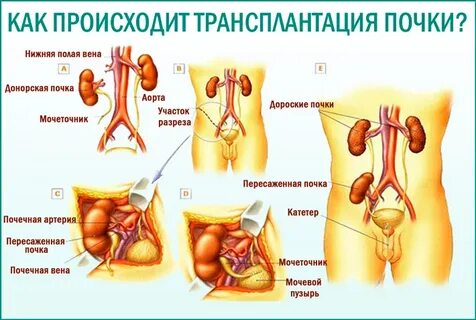 Сколько время операция почки