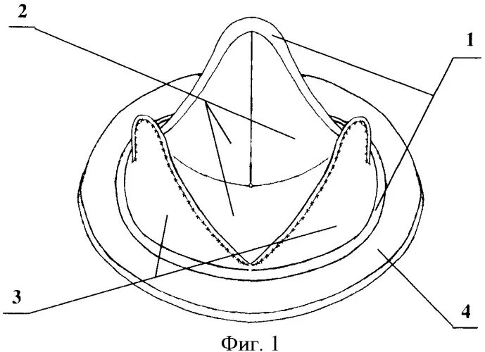 Замена митрального клапана сердца бакулева. Протез митрального клапана сердца. Хирургическое лечение пролапса митрального клапана. Как называются клапаны сердца. Митральный и аортальный клапан.