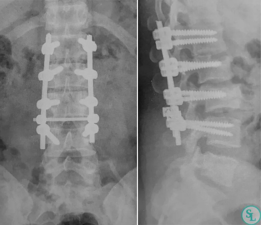 Транспедикулярная фиксация поясничного отдела позвоночника рентген. Транспедикулярная фиксация l1-l2-l3-l4-l5 системой. Перелом 12 грудного позвонка рентген.