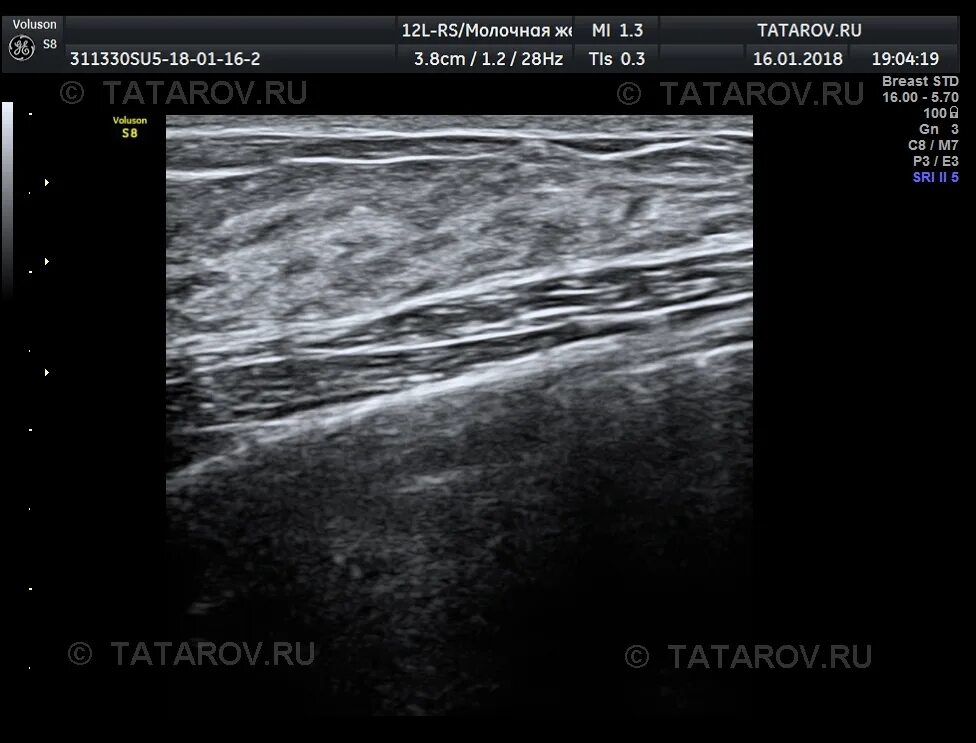 Записаться на узи молочной железы. Ультразвуковая анатомия молочных желез. УЗИ мол жел норма. Олеогранулемы молочной железы на УЗИ. Протоки молочной железы на УЗИ терминальные.