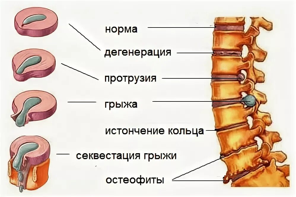 Грыжа позвоночника протрузия и остеохондроз. Стадии развития остеохондроза позвоночника. Степени грыжи диска позвоночника. Патогенетические стадии остеохондроза позвоночника. Экструзия дисков шейного отдела позвоночника